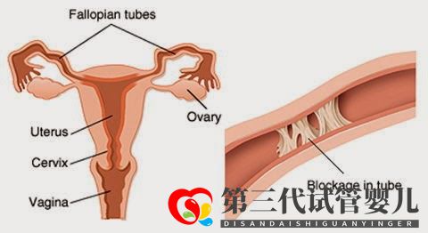 输卵管堵塞,怀孕到底有多难(图5)
